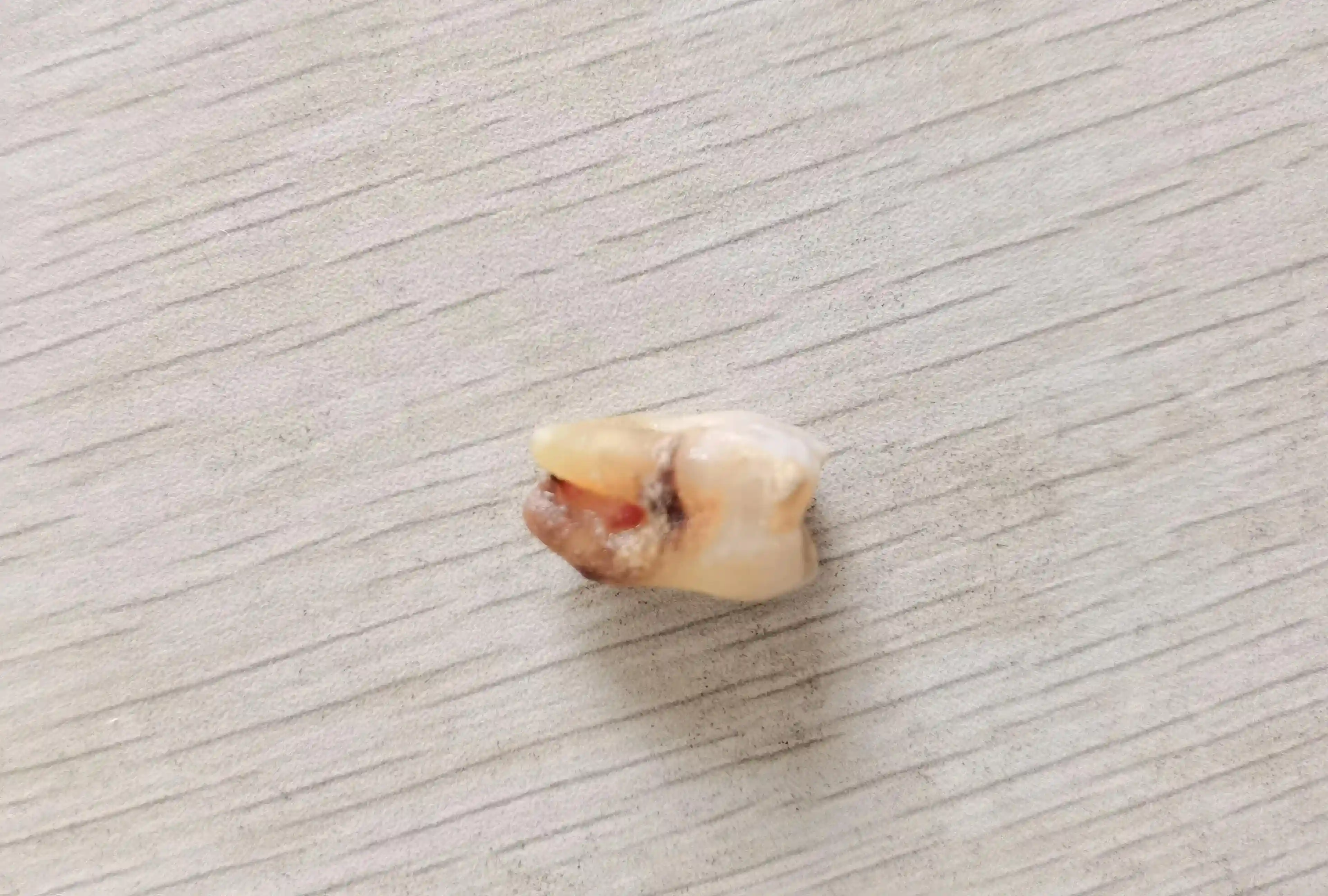 没到五十岁，牙齿就开始脱落，牙周炎一定要早治