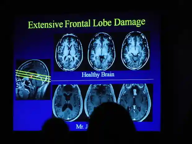 十一个有趣的冷知识, 人类没有大脑也能存活?