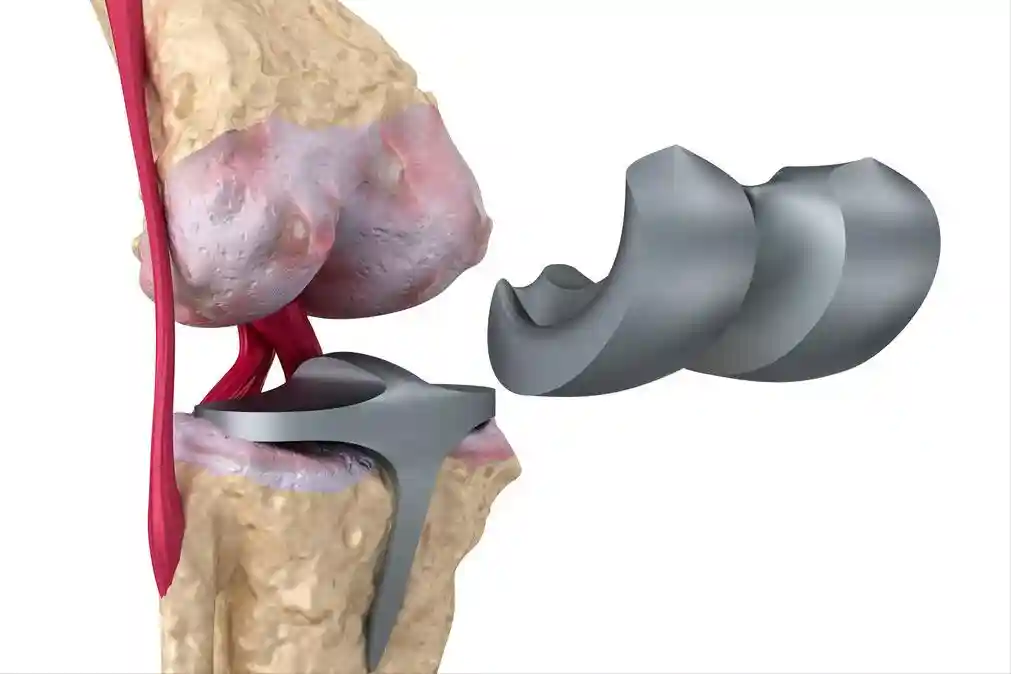 不做手术也能修复软骨？PRP治疗膝骨关节炎是安慰剂还是及时雨？